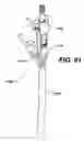 Fig. 59 - Assembly tool for modular implants, kit and associated method