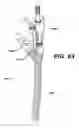 Fig. 61 - Assembly tool for modular implants, kit and associated method