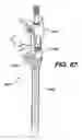 Fig. 65 - Assembly tool for modular implants, kit and associated method