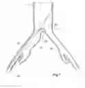 Fig. 06 - Stent graft introducer