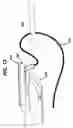 Fig. 14 - Tissue grasper/suture passer instrument