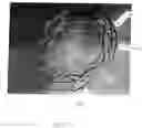 Fig. 13 - ANASTOMOTIC DEVICE PROMOTING TISSUE NECROSIS