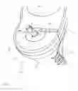 Fig. 03 - Retrograde excision system and apparatus