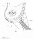 Fig. 04 - Retrograde excision system and apparatus