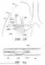 Fig. 03 - DEVICES AND METHODS FOR MAINTAINING COLLATERAL CHANNELS IN TISSUE
