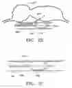 Fig. 04 - DEVICES AND METHODS FOR MAINTAINING COLLATERAL CHANNELS IN TISSUE