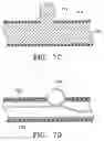 Fig. 19 - DEVICES AND METHODS FOR MAINTAINING COLLATERAL CHANNELS IN TISSUE