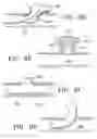 Fig. 21 - DEVICES AND METHODS FOR MAINTAINING COLLATERAL CHANNELS IN TISSUE