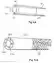 Fig. 04 - Embolic protection system