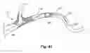 Fig. 20 - Embolic protection system