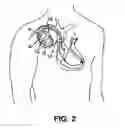 Fig. 03 - Medical device packaging system