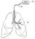 Fig. 01 - APPARATUS FOR TREATING AIRWAYS IN THE LUNG