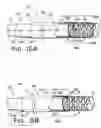 Fig. 13 - Over the endoscope introducer for stents