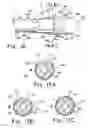 Fig. 14 - Over the endoscope introducer for stents