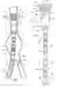Fig. 02 - Modular stent graft assembly and use thereof