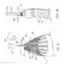Fig. 11 - Modular stent graft assembly and use thereof