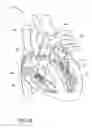 Fig. 02 - Apparatuses and methods for heart valve repair