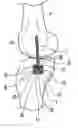 Fig. 01 - Ligament attachment and repair device
