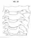 Fig. 33 - Intervertebral disc and insertion methods therefor