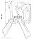 Fig. 35 - Intervertebral disc and insertion methods therefor