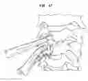 Fig. 41 - Intervertebral disc and insertion methods therefor