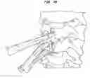 Fig. 42 - Intervertebral disc and insertion methods therefor