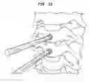 Fig. 47 - Intervertebral disc and insertion methods therefor