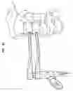 Fig. 48 - Intervertebral disc and insertion methods therefor