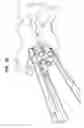Fig. 49 - Intervertebral disc and insertion methods therefor