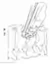 Fig. 52 - Intervertebral disc and insertion methods therefor