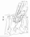 Fig. 53 - Intervertebral disc and insertion methods therefor