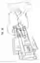 Fig. 63 - Intervertebral disc and insertion methods therefor