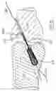 Fig. 05 - Tapered anchor for tendon graft