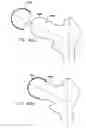 Fig. 103 - Foldable prosthetic implant element
