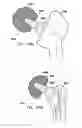 Fig. 110 - Foldable prosthetic implant element