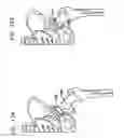 Fig. 13 - Foldable prosthetic implant element