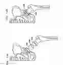 Fig. 15 - Foldable prosthetic implant element