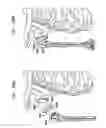 Fig. 29 - Foldable prosthetic implant element