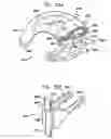 Fig. 30 - Foldable prosthetic implant element