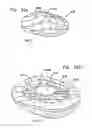 Fig. 31 - Foldable prosthetic implant element