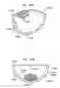 Fig. 76 - Foldable prosthetic implant element