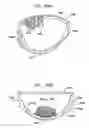 Fig. 77 - Foldable prosthetic implant element