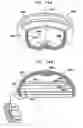 Fig. 93 - Foldable prosthetic implant element