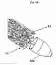 Fig. 03 - Internally Placed Gastric Restriction Device