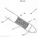 Fig. 06 - Internally Placed Gastric Restriction Device