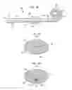 Fig. 03 - Prevention of static bonding between medical device components