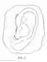 Fig. 03 - Tinnitus treatment device
