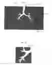 Fig. 04 - Branch extension method for airway segmentation