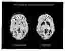 Fig. 01 - METHOD TO DETECT DOPAMINE RECEPTORS IN THE FUNCTIONAL D2HIGH STATE