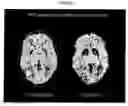 Fig. 02 - METHOD TO DETECT DOPAMINE RECEPTORS IN THE FUNCTIONAL D2HIGH STATE